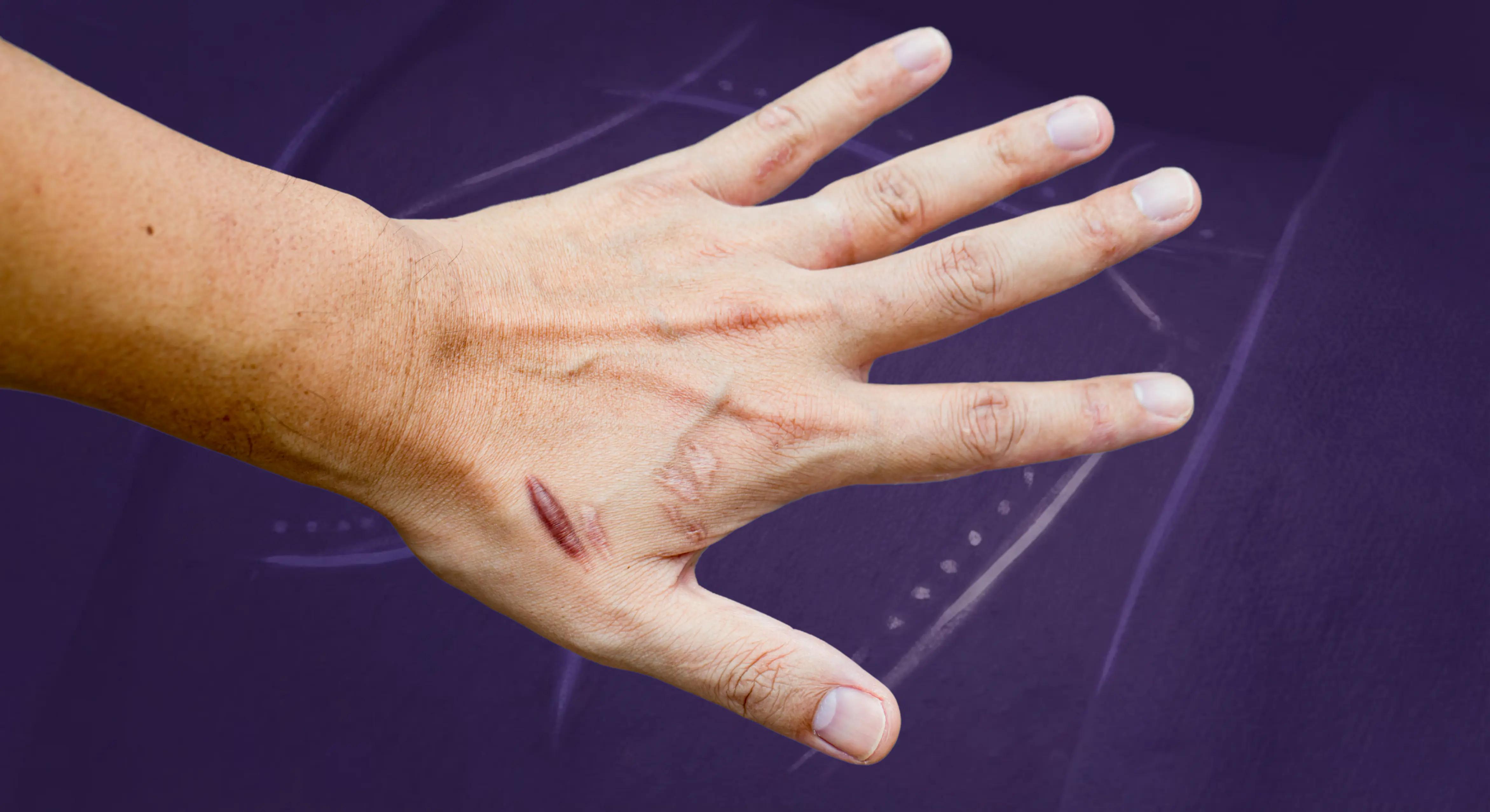 Keloid Treatment and Scar Revision