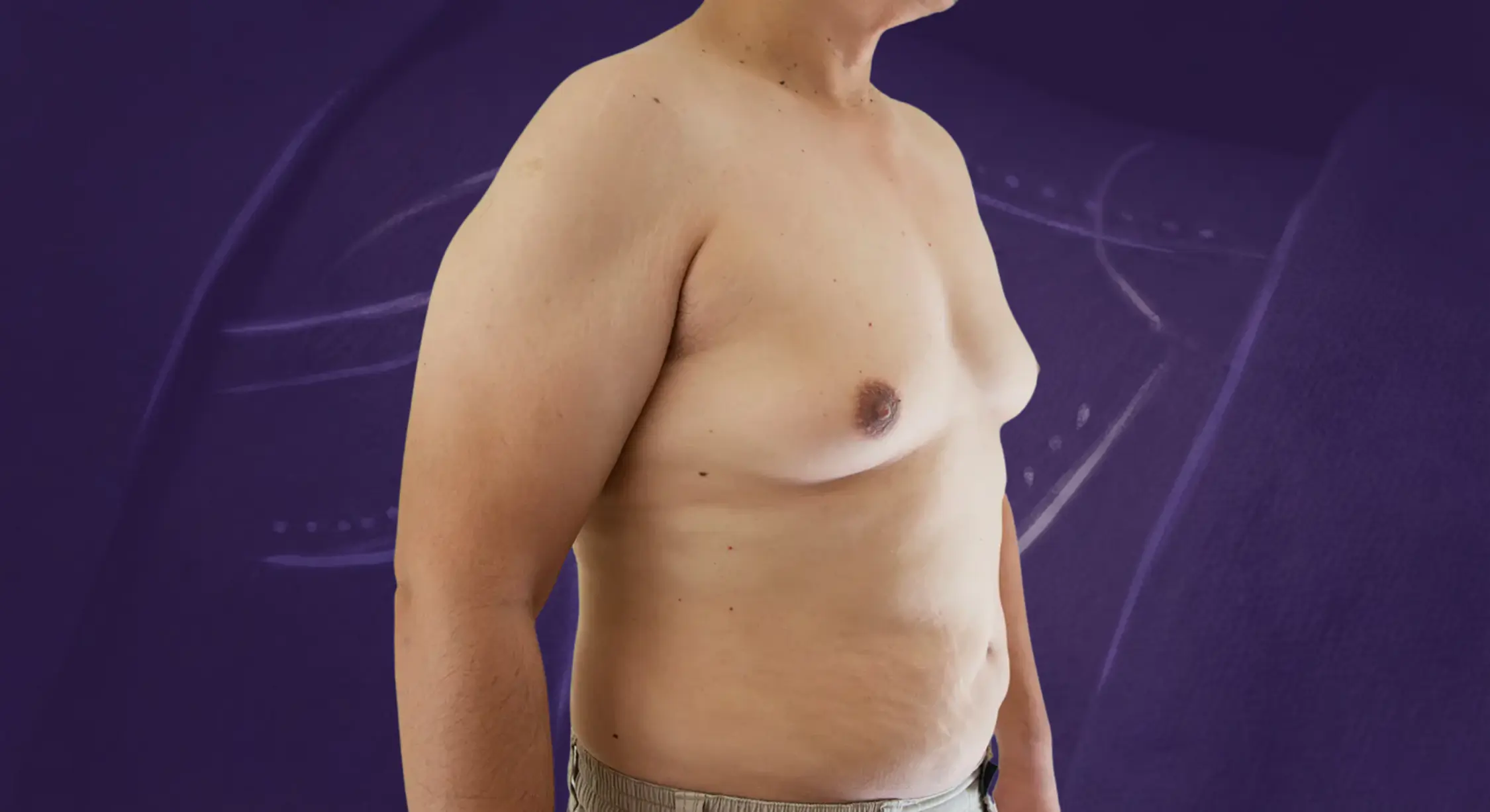 Male Breast Reduction Gynecomastia